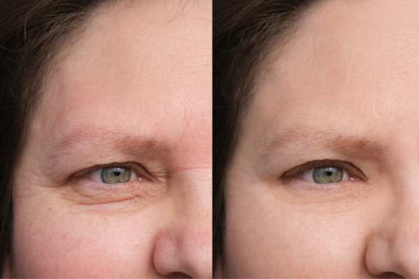 HIFU vs Botulinum Toxin: Understanding the Differences 4 How long do HIFU results last Moss Side?